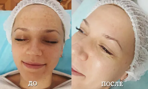 Атравматическая чистка лица Атравматическая чистка лица