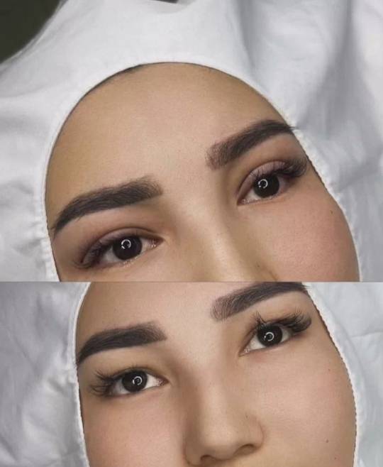 Нитевая блеферопластика Нитевая блеферопластика